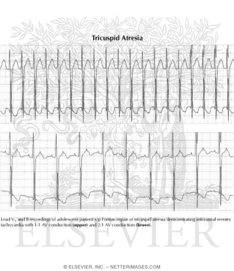 Tricuspid Atresia
