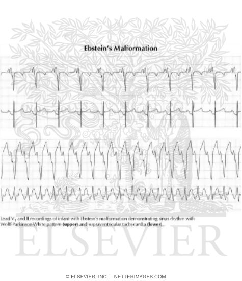 Ebstein's Malformation