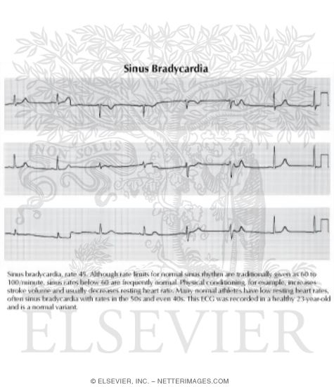 Watermarked preview of labeled image: Sinus Bradycardia