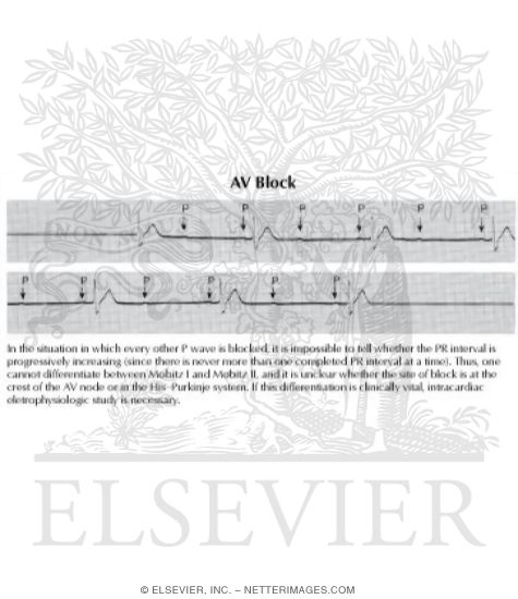 Watermarked preview of labeled image: AV Block