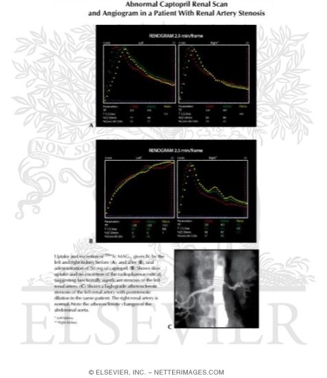 Abnormal Captopril Renal Scan and Angiogram In a Patient With Renal Artery Stenosis