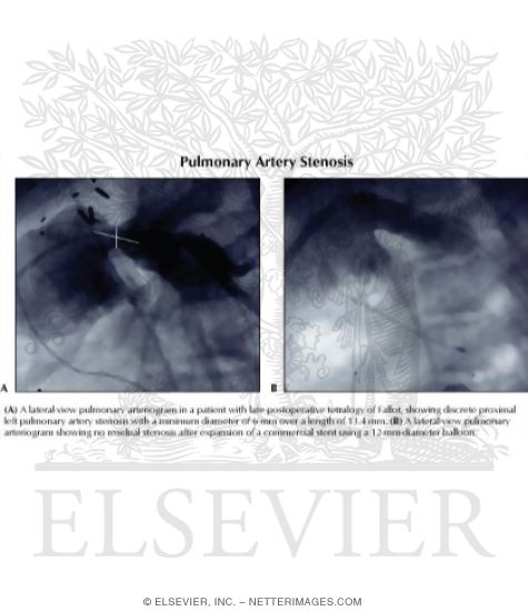 Watermarked preview of labeled image: Pulmonary Artery Stenosis