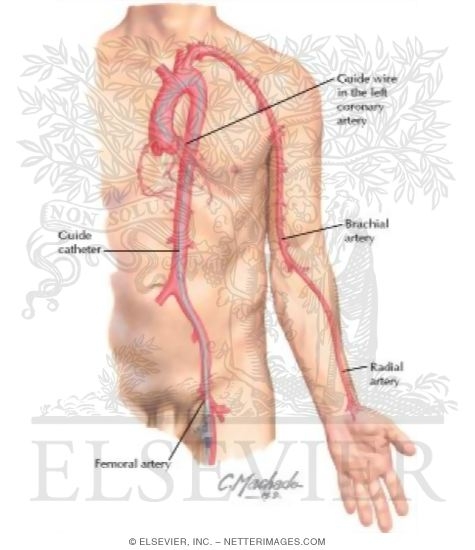 Watermarked preview of labeled image: Percutaneous Coronary Intervention: Vascular Access