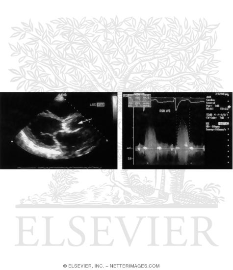 Watermarked preview of unlabeled image: Two-Dimensional Echocardiography and Doppler Analysis In a Patient With Aortic Stenosis