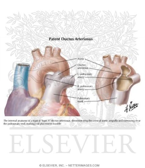 Patent Ductus Arteriosus