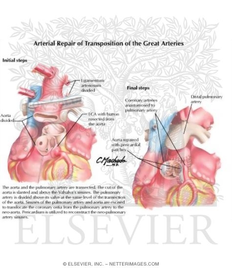Watermarked preview of labeled image: Arterial Repair of Transposition of the Great Arteries