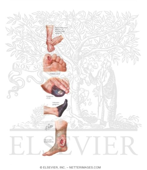 Watermarked preview of labeled image: Vascular Insufficiency In Diabetes
Complications of Diabetic Vasculopathy and Neuropathy