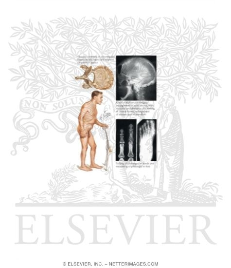 Watermarked preview of labeled image: Acromegaly