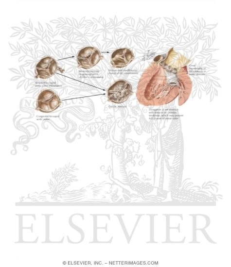 Watermarked preview of labeled image: Rheumatic Heart Disease X - Aortic Stenosis
Rheumatic and Nonrheumatic Causes of Aortic Stenosis