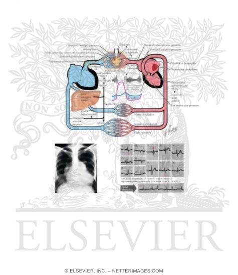Watermarked preview of labeled image: Pathophysiology and Clinical Aspects of Mitral Stenosis