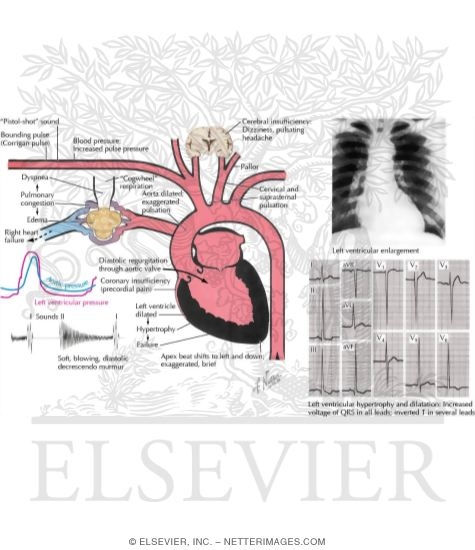Watermarked preview of labeled image: Aortic Insufficiency
Manifestations of Aortic Insufficiency
Valvular Stenosis and Insufficiency