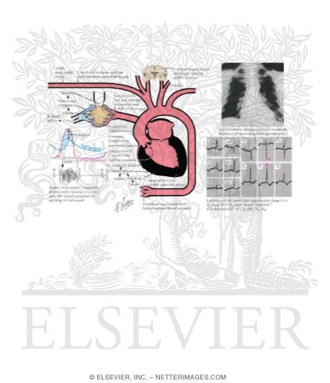 Watermarked preview of labeled image: Aortic Stenosis