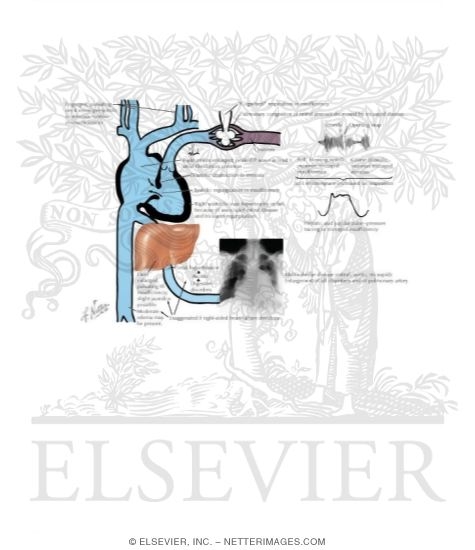 Watermarked preview of labeled image: Valvular Stenosis and Insufficiency
Tricuspid Stenosis and/or Insufficinecy