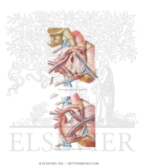 Watermarked preview of labeled image: Defects of the Atrial Septum