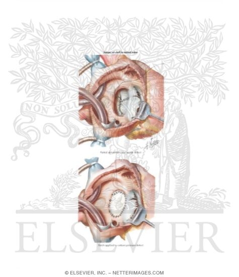 Watermarked preview of labeled image: Endocardial - Cushion Defects