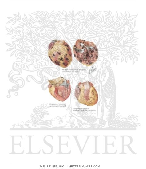Watermarked preview of labeled image: Metastatic Heart Tumors