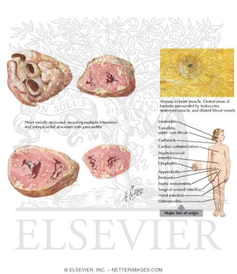 Septic Myocarditis