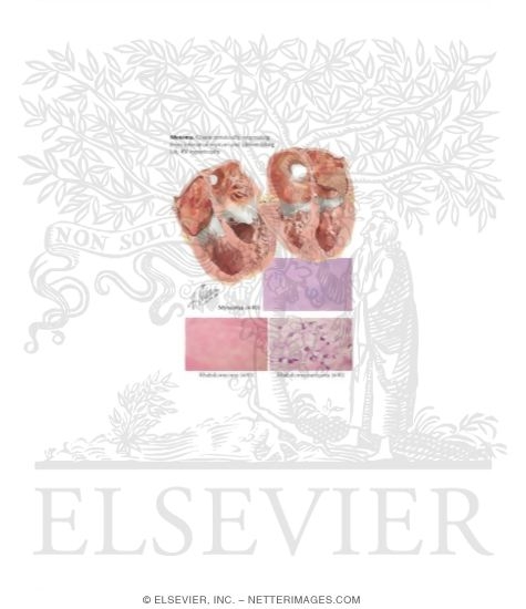 Watermarked preview of labeled image: Heart Tumors