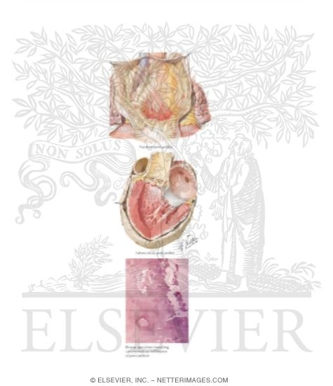 Watermarked preview of labeled image: Diseases of Pericardium