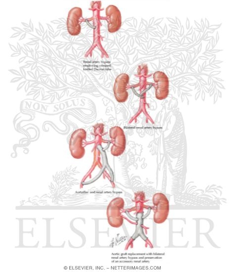 Watermarked preview of labeled image: Renal Revascularization