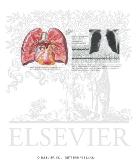 Watermarked preview of labeled image: Massive Embolization