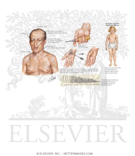 Watermarked preview of labeled image: Myotonic Dystrophy