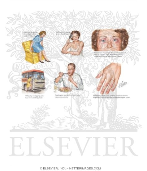 Watermarked preview of labeled image: Polymyositis and Dermatomyositis
