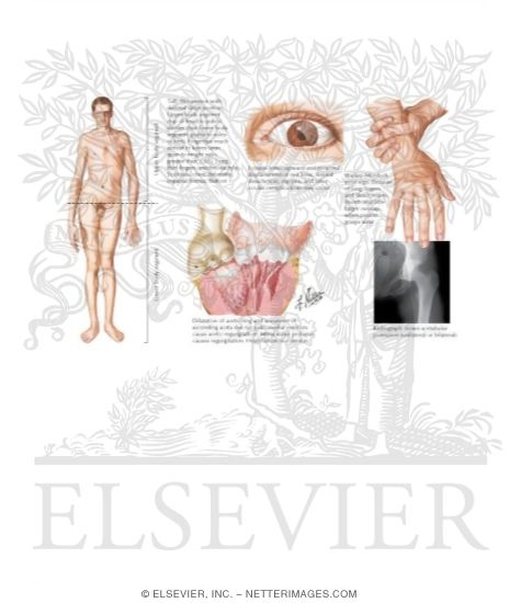 Watermarked preview of labeled image: Marfan's Syndrome