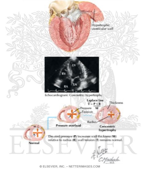 Watermarked preview of labeled image: Left Ventricular Hypertrophy
