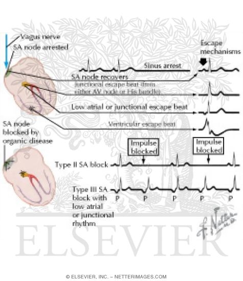 Watermarked preview of labeled image: Sinus Arrest and Sinus Block