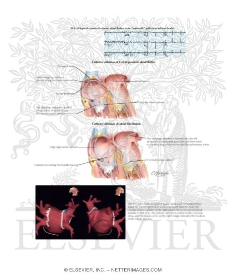 Atrial Flutter, Atrial Tachycardia, and Atrial Fibrillation