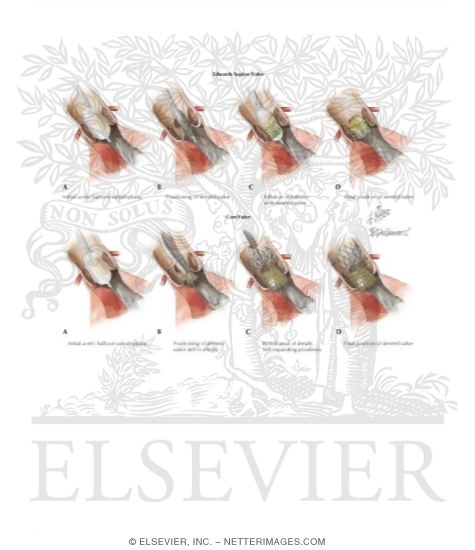 Watermarked preview of labeled image: Percutaneous Aortic Valve (Edwards Sapien and CoreValve) Replacement