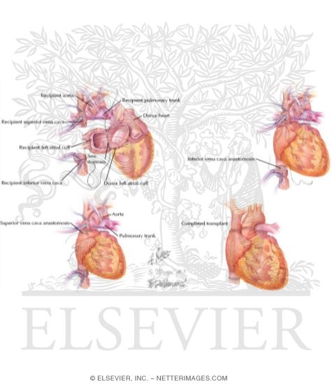 Watermarked preview of labeled image: Technique of Bicaval Cardiac Transplantation
