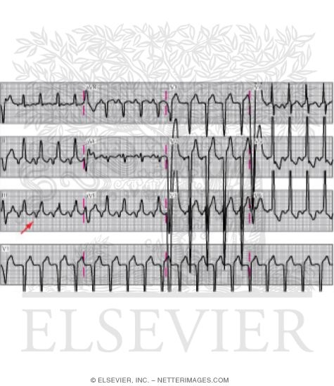 Long RP Tachycardia With Inverted P Waves Highlighted By Arrow