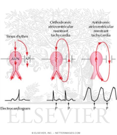 Mechanism of Atrioventricular Reentrant Tachycardia In Patients With the Wolff-Parkinson-White-Syndrome