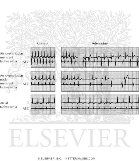 Watermarked preview of unlabeled image: Effect of Adenosine On Atrioventricular Reentrant Tachycardia, Atrioventricular Nodal Reentrant Tachycardia, and Atrial Tachycardia