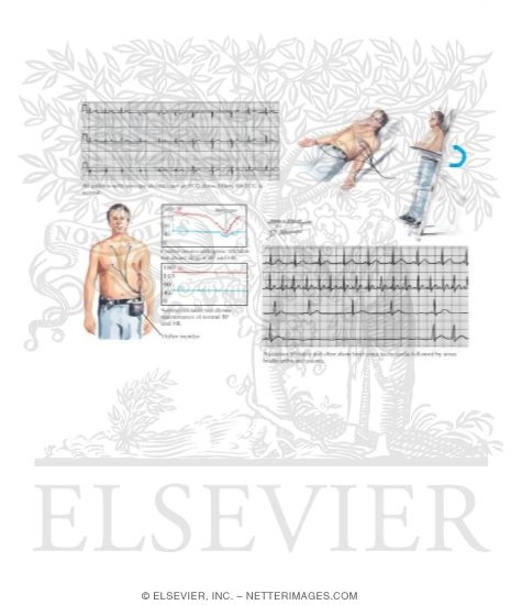 Syncope: Diagnostic Evaluation