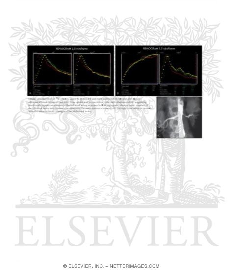 Abnormal Captopril Renal Scan and Angiogram In a Patient With Renal Artery Stenosis