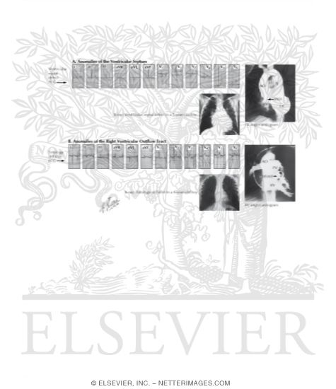 Watermarked preview of unlabeled image: Anomalies of the Ventricular Septum and of the Right Ventricular Outflow Tract