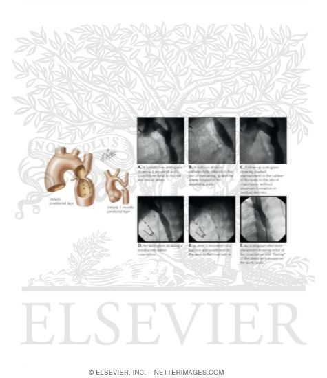 Watermarked preview of labeled image: Coarctation of the Aorta