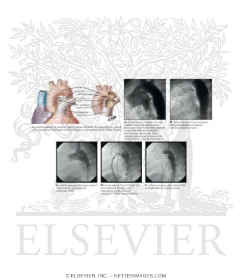 Watermarked preview of labeled image: Patent Ductus Arteriosus