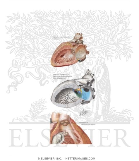 Watermarked preview of unlabeled image: Anatomic Features of Perimembranous and Muscular Ventricular Septal Defects