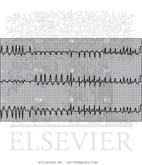 Wolff-Parkinson-White Syndrome With Rapid Atrial Fibrillation