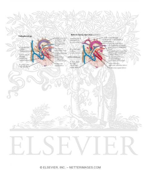 Watermarked preview of labeled image: Tetralogy of Fallot
