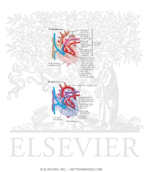 Watermarked preview of labeled image: Interrupted Aortic Arch Complex