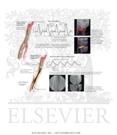 Watermarked preview of labeled image: Types of Arterial Noninvasive Tests