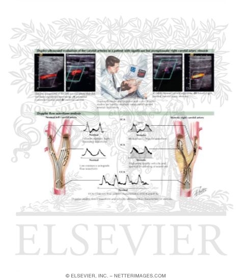 Watermarked preview of labeled image: Noninvasive Evaluation of Carotid Arteries
