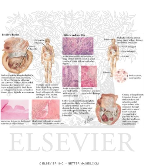 Watermarked preview of labeled image: Endomyocardial Causes of Restrictive Cardiomyopathy