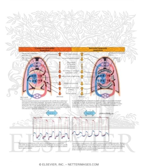 Normal Cardiac Blood Flow During Inspiration and Expiration