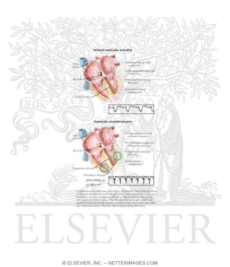 Watermarked preview of labeled image: Atrial Fibrillation